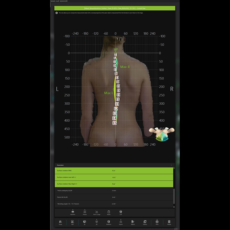 Система трёхмерного сканирования позвоночника Spine3D